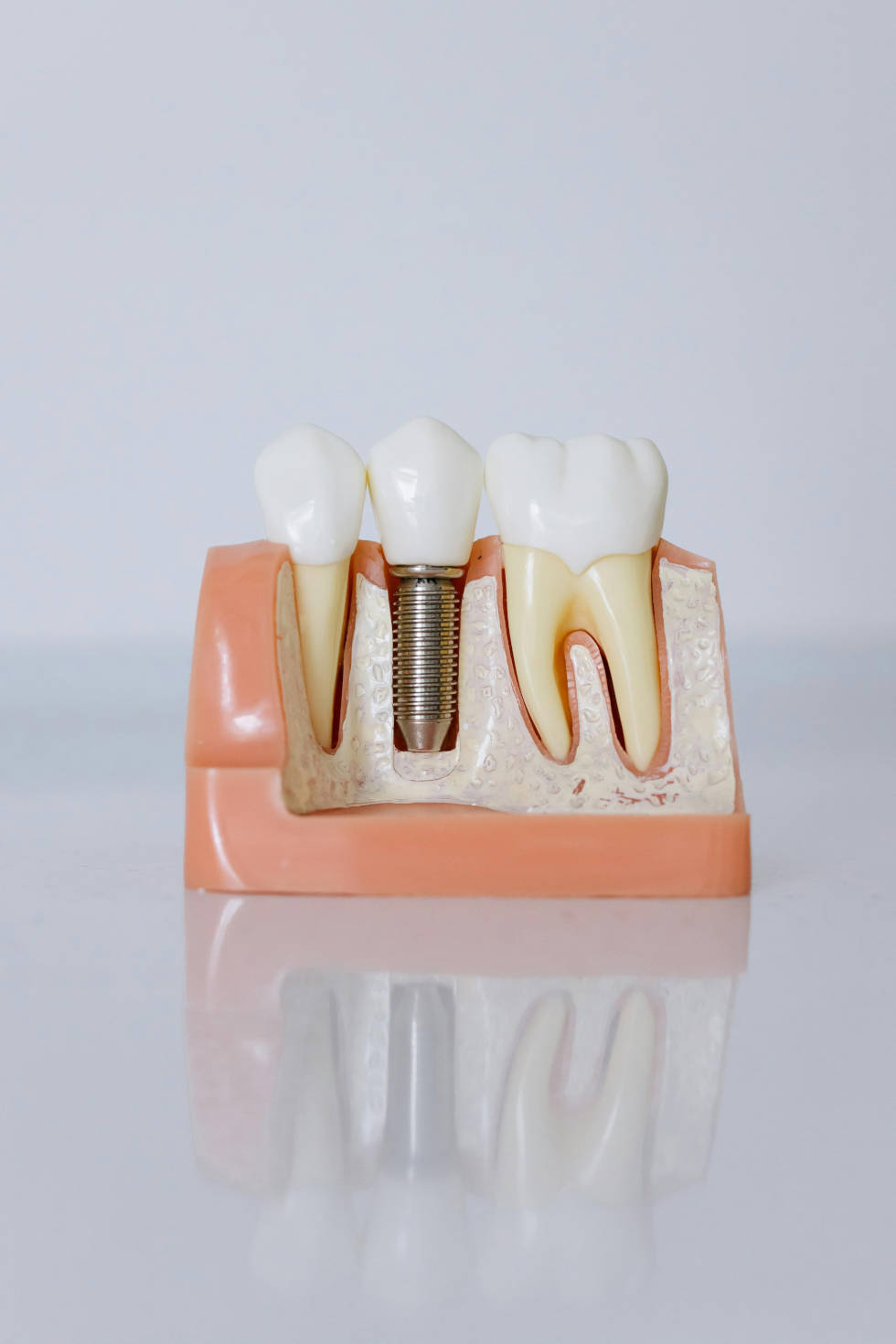 implant